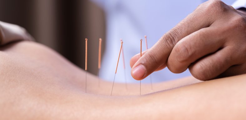 Кодирование иглоукалыванием